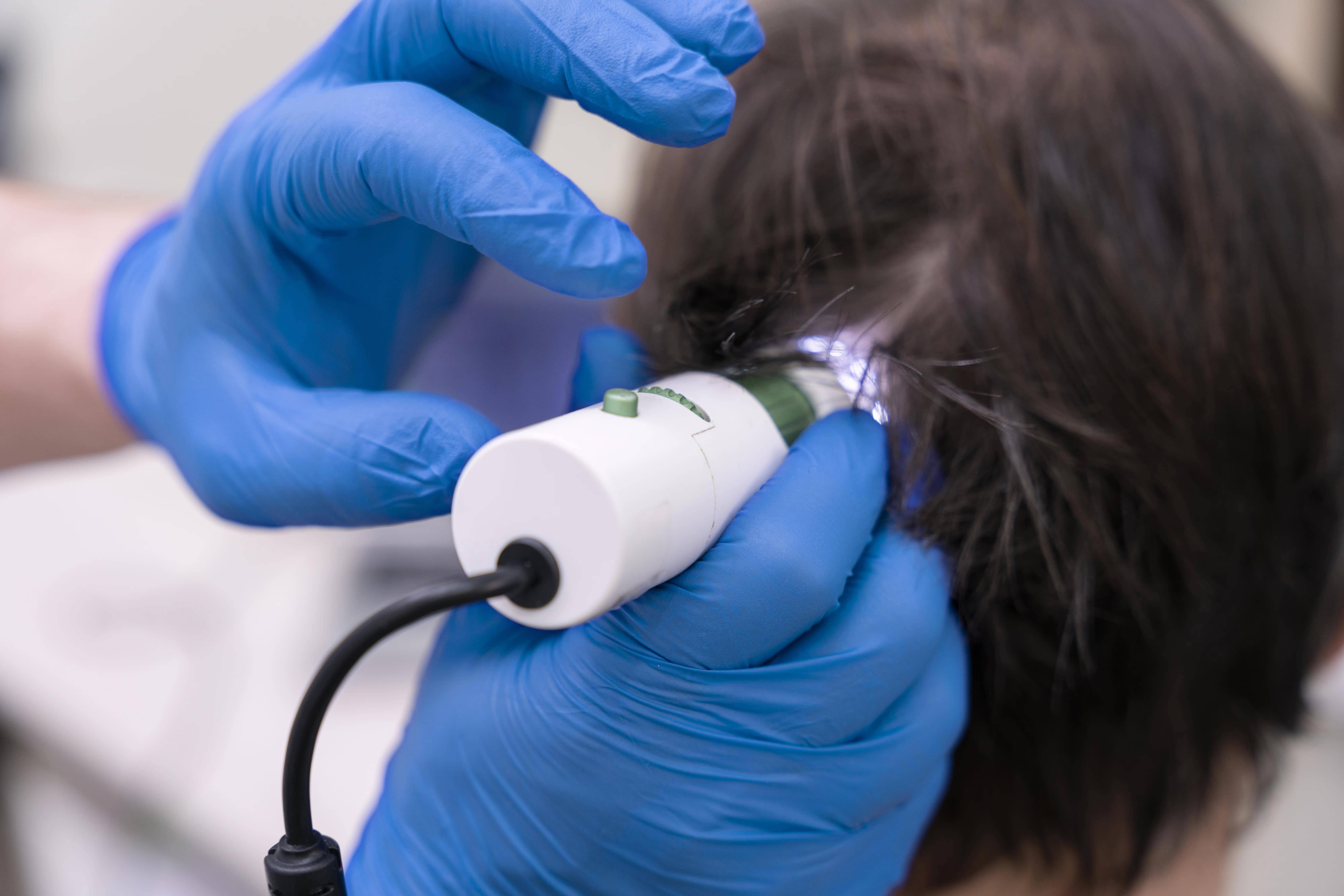 Dermoscopy/trichoscopy treatment