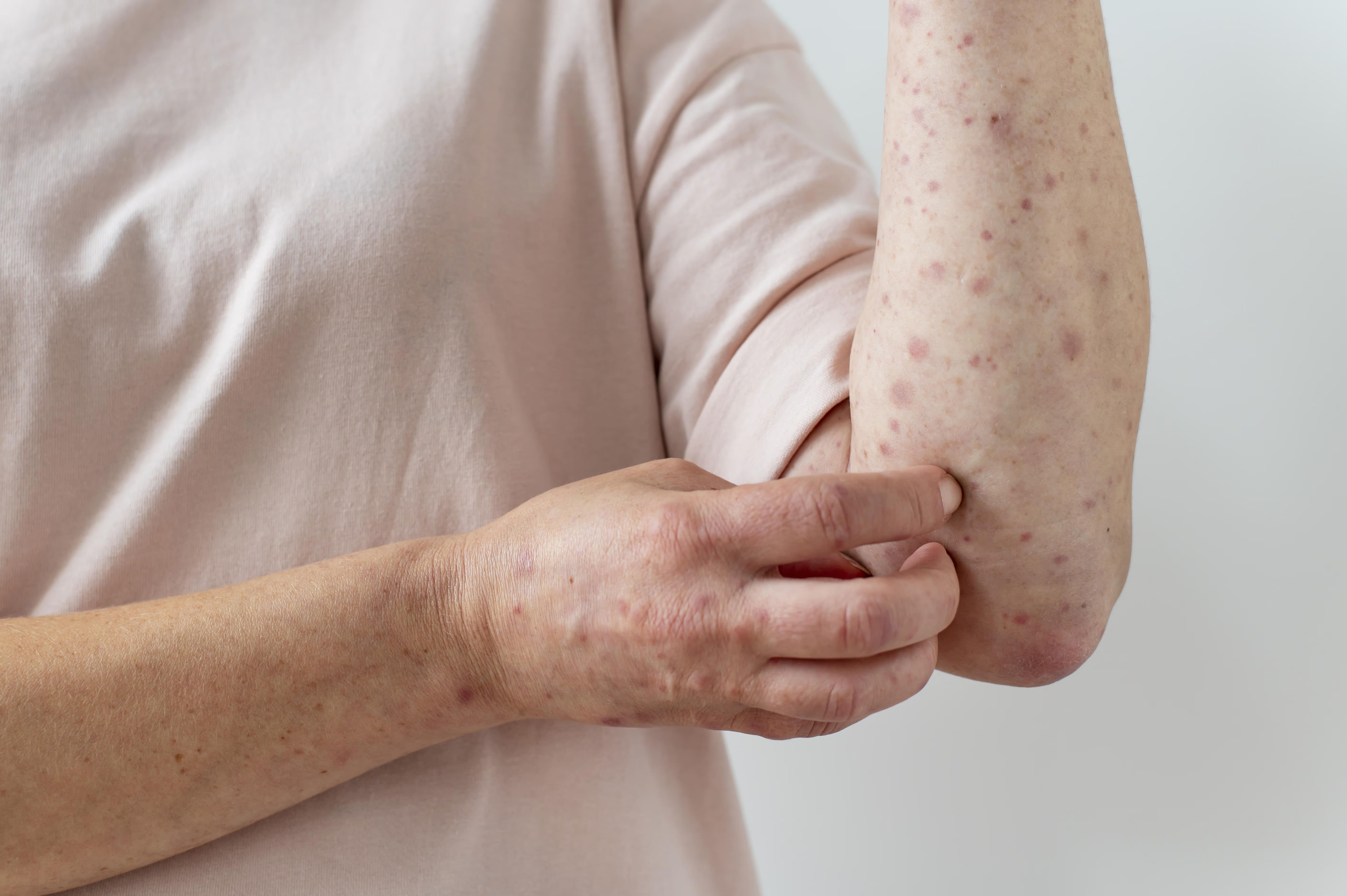 Leprology treatment
