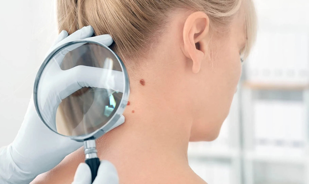 Skin Cancer Awareness: A Guide to Detecting